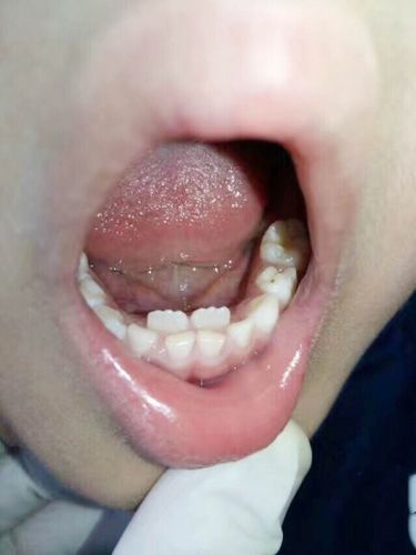 男孩轩轩(化名)一张嘴,在正常的下门牙位置后方的牙龈上,能看到还长有