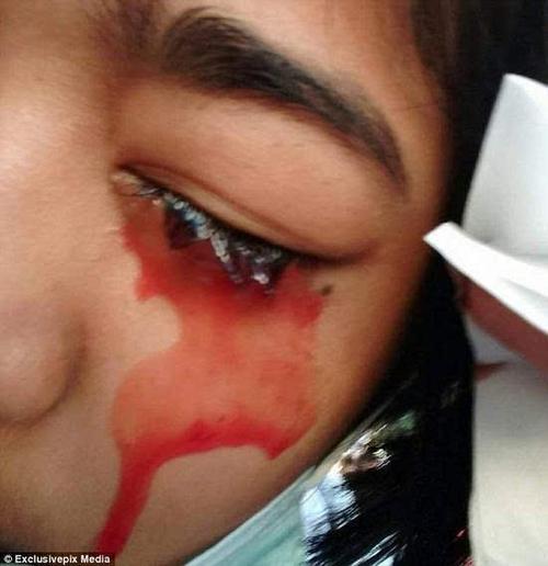 泰国女孩患上神秘怪病 头痛时眼鼻耳和皮肤都流血