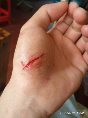 今天手被刀割了一个口子流了很多血过了三四分钟去买了创口贴刚走出小