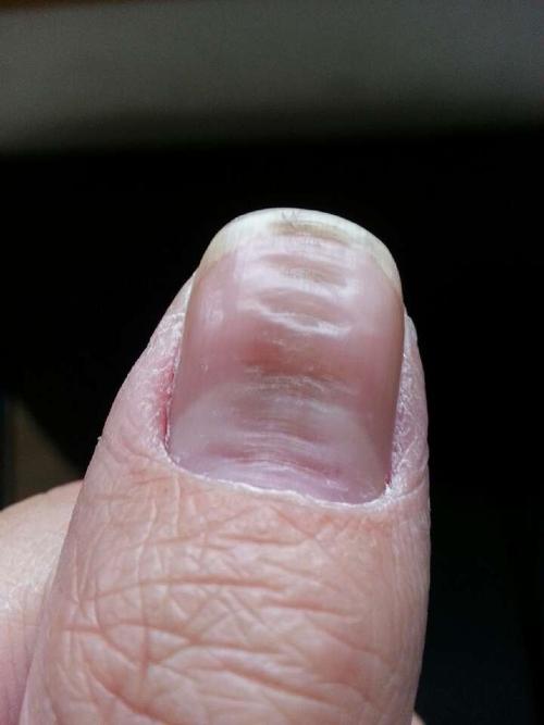 大拇指甲以前稍微有点凹现在严重了,吃了几个月的钙片也没见好转时怎