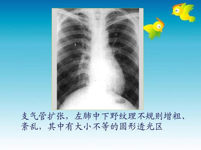 支气管扩张,左肺中下野纹理不规则增粗, 紊乱,其中有大小不等的圆形