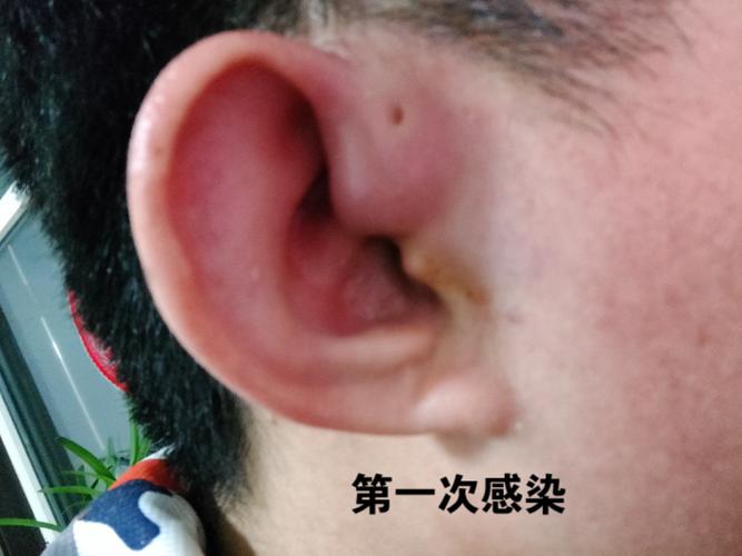 耳前瘘管感染切开引流后手术到恢复全过程