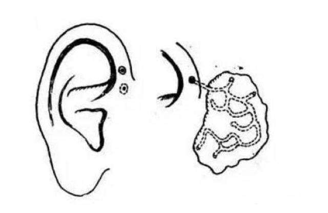 耳前瘘管是一种常见的先天性畸形,患者平时除仅感到局部刺痒外,有时
