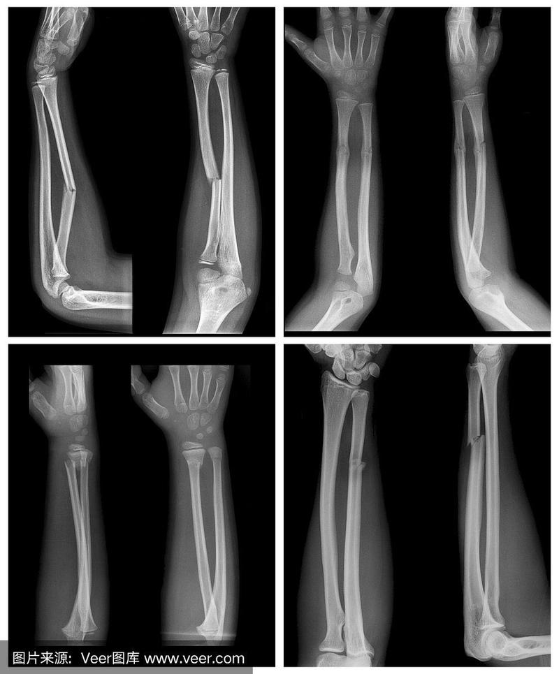 儿童前臂骨折(桡骨,尺骨)x线照片收集