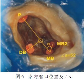 右侧上颌第一磨牙mb2根管诊疗分析