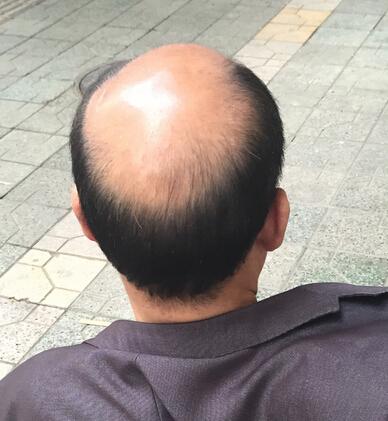 在指定发型的清朝,秃顶的人怎么保命?
