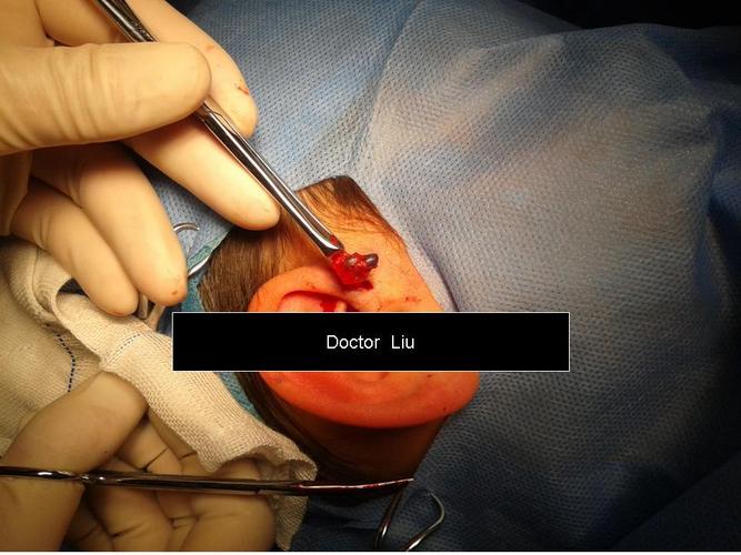 先天性耳前瘘管手术中 - 好大夫在线