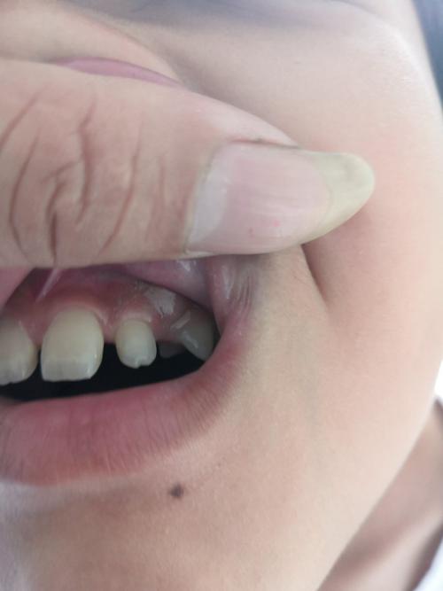 小孩牙齿长出二层