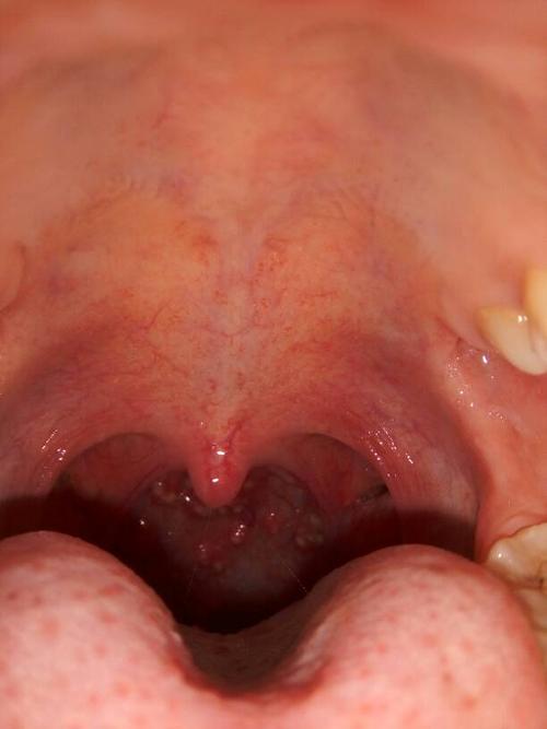 喉咙里面的这些泡泡怎么回事?