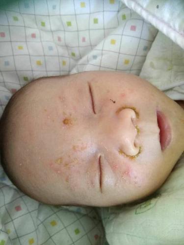 4,新生儿脸上有湿疹怎么办1  1保持皮肤干爽不要用烫的水给宝宝洗脸