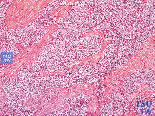 膀胱嗜铬细胞瘤病理图谱