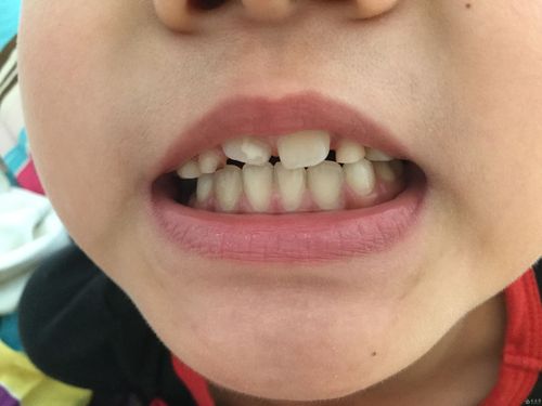 请各位老师确诊一下门牙上的白斑