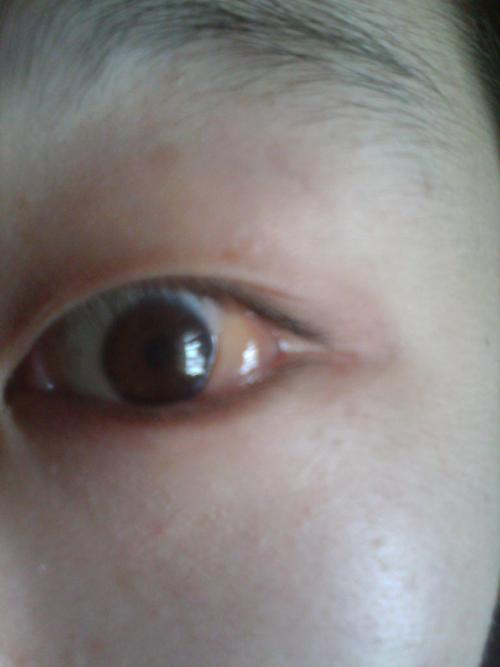 病情描述(发病时间,主要症状等): 之前左眼外眼角内侧涨了一个小疙瘩