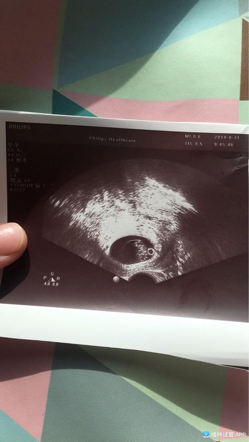 亲们谁会看b超单,8周的b超,孕囊里那个白色小圈圈是啥