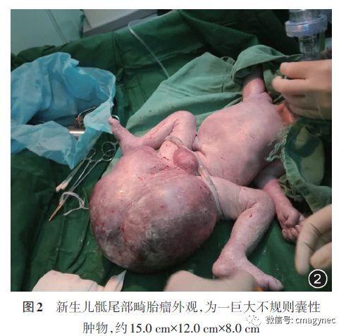 胎儿巨大骶尾部畸胎瘤一例