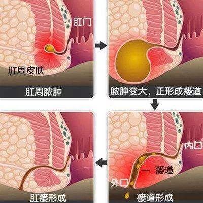 但肛瘘起发于直肠附近,由于盆腔发生炎症,直肠粘膜受到损伤,细菌通过