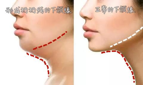 北京星医汇张龙金主任下颌缘吸脂和双下巴吸脂部位有什么区别