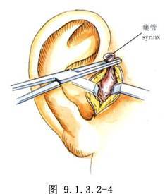 耳前瘘管摘除术