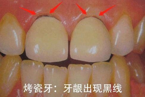 烤瓷牙的区别主要在内冠,前者是瓷,后者是金属,而金属会导致牙龈发黑