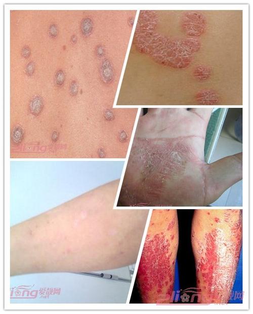 为红色丘疹或斑丘疹,以后逐渐扩大或融合成片,鲜红或深红色,高出皮肤