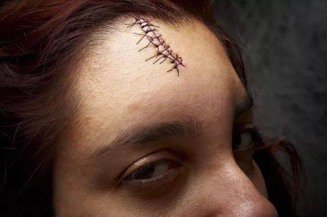 在发际线处出现的痕,疤对人寿命的影响很大,影响到印堂之上大半个额头
