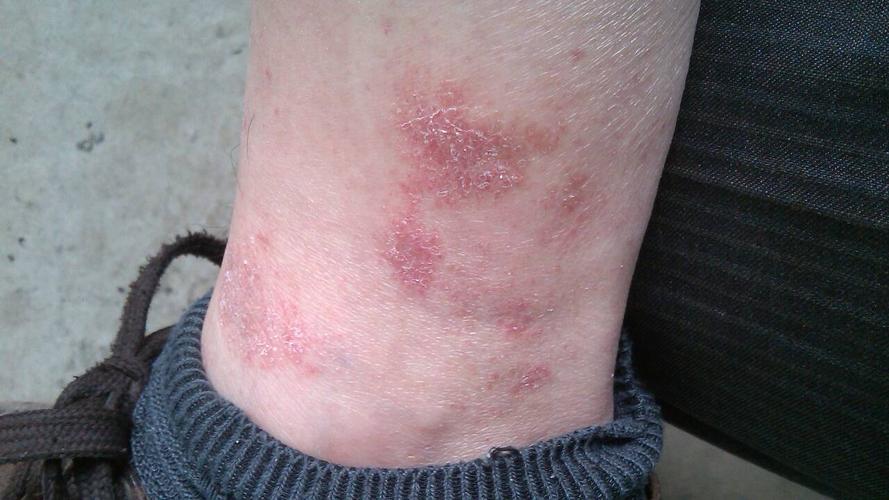 我的双腿有很多象针点的红斑反复发作,有二个月了,说是毛细血管破裂