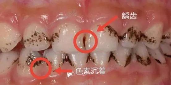 牙齿上的黑斑是怎么回事?