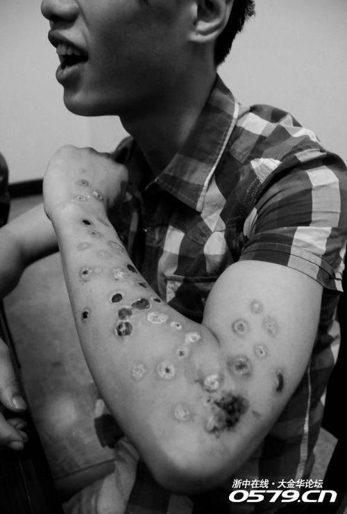 为纪念自己失去的初恋,18岁小伙拿烟头在左手臂上烫了38个伤疤(图)