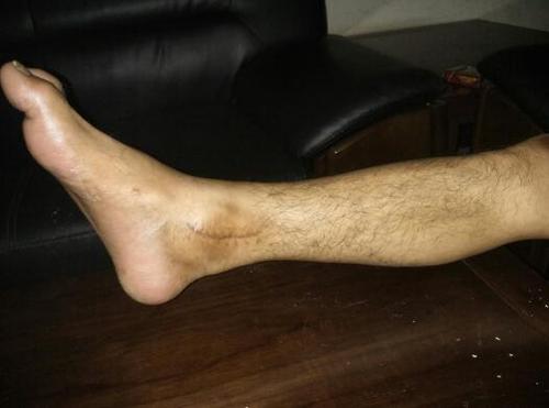 脚裸处粉碎性骨折,受伤两个多个月了,动完手术后,现在小腿经常萎缩