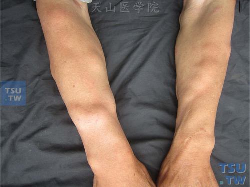 该病人双上肢见多处柔软,分叶状皮下肿物,可移动,对称分布,表面皮肤