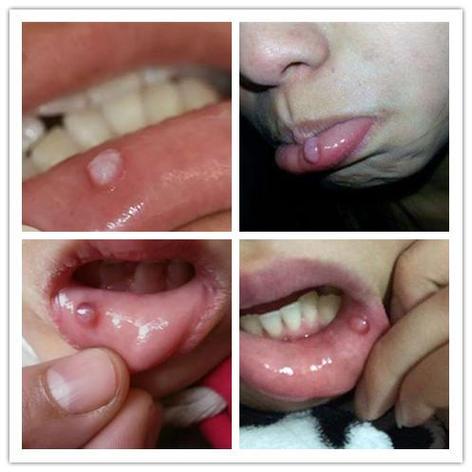 这种嘴唇里长的疙瘩有个专业诊断名"粘液腺囊肿",常发生于唇粘膜,其次