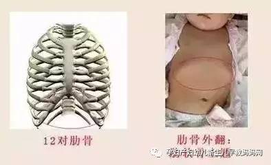 掀开宝宝胸部的衣服,你会发现宝宝胸部肋骨下缘明显地高出来,同时腹部
