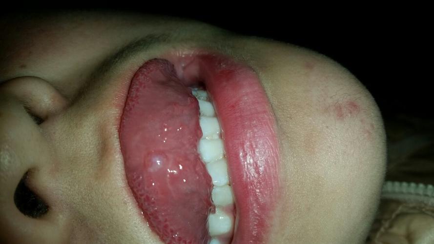 请问十三岁孩子舌头上长泡是怎么了?有医生说是粘液腺囊肿,是吗?