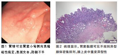胃镜可见胃窦小弯侧浅表隆起性病变,20mm×15mm大小,表面充血