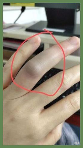 手指浮肿是什么原因?