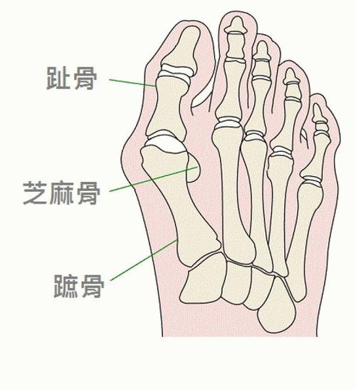 拇趾跟脚掌之间的关节称为第一跖趾关节.