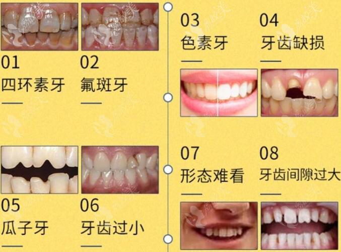 间隙牙,门牙缺陷,过小牙,牙齿轻微不整齐牙齿色泽缺陷:四环素牙