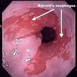 消化科普丨胃镜报告里的"barrett食管"是什么