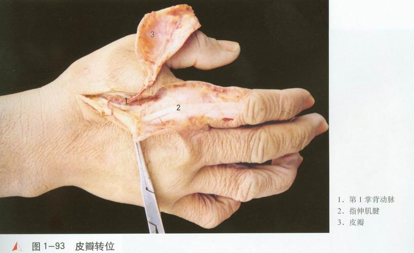 应用解剖   第1掌背动脉[1]多数起于桡动脉[2](约70%)的鼻烟窝段,其