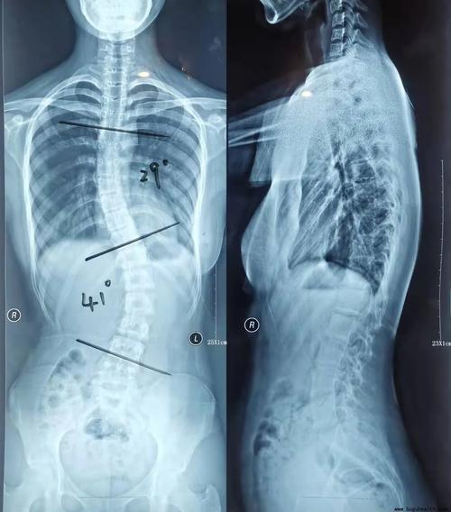布骨医学科普:不同角度看脊柱——脊柱冠状面弯曲角度的测量,布骨医疗