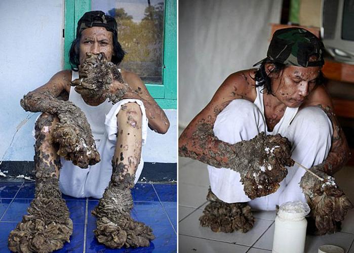 印尼"树人"抱憾去世 至死未能治愈怪病