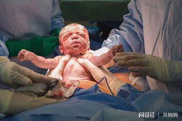 孕妇剖腹产胎儿被划伤医生拒绝赔偿避免胎儿受伤孕妈妈这样做