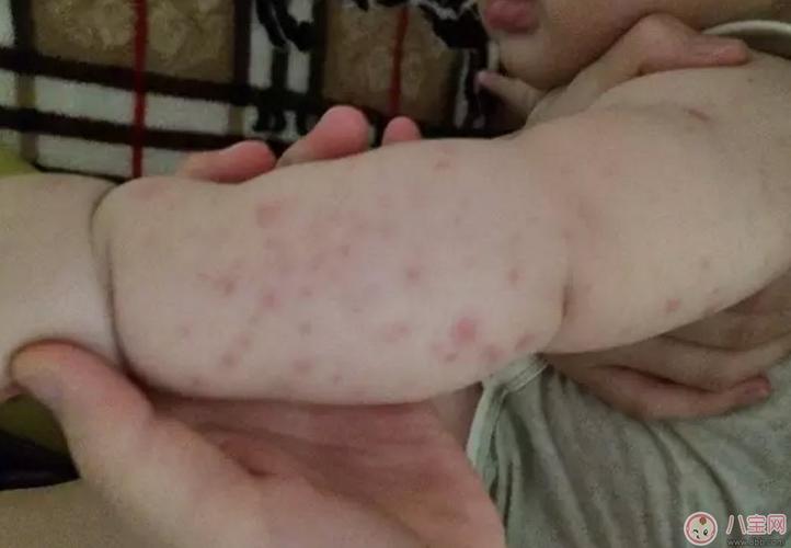 宝宝螨虫过敏怎么办,宝宝被螨虫咬和蚊子咬症状对比图片区别