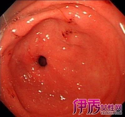 男35岁胃镜检查糜烂性胃窦炎,1年多了药物治疗症状没有缓解?