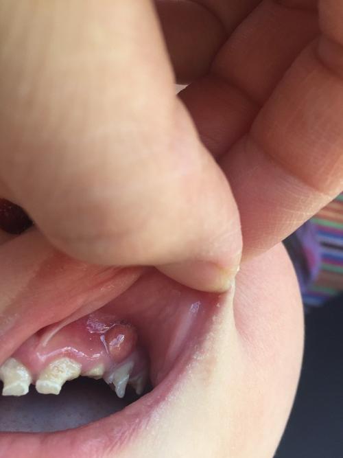 幼儿牙龈上长了个疙瘩,想问一下是怎么回事?需要怎么治疗,谢谢