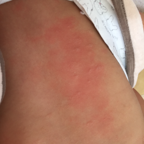 [过敏宝宝]宝宝背上长的是湿疹吗?