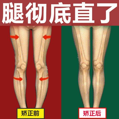 小腿变直xo矫正假胯养成神器腿型纠正直腿矫姿用品