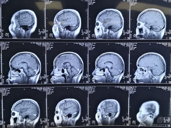 跨越20余年的全脑干和小脑萎缩——病因? [病例帖]
