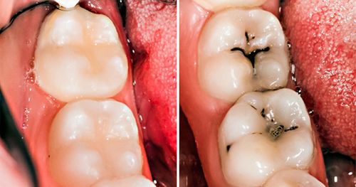 牙齿蛀烂才看医生? 8个「天然护理方法」助你长保口腔健康