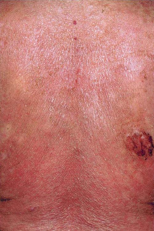 114红皮病型皮肤t细胞淋巴瘤